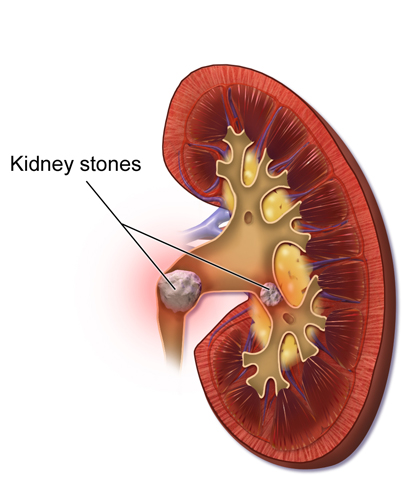 Kidney Stone Removal Surgery