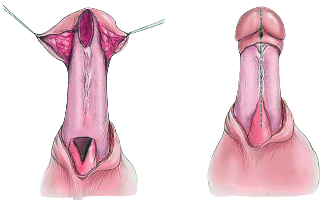 Urethroplasty-Surgery-in-Gurugram