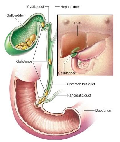 bladder-stone