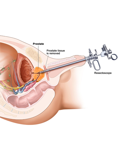 prostate-surgery